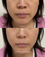 RF Lifting Facial